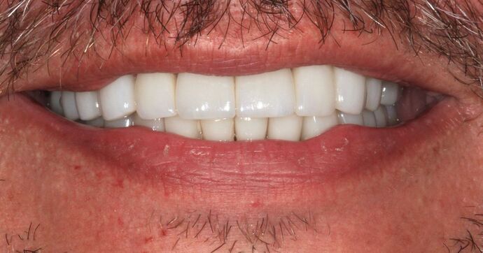 Full Mouth Reconstruction: Case 46 - After