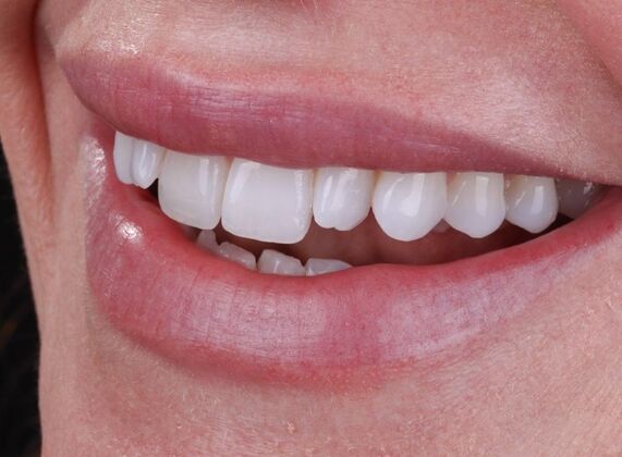 Smile Makeover & Veneers: Crystal - Before