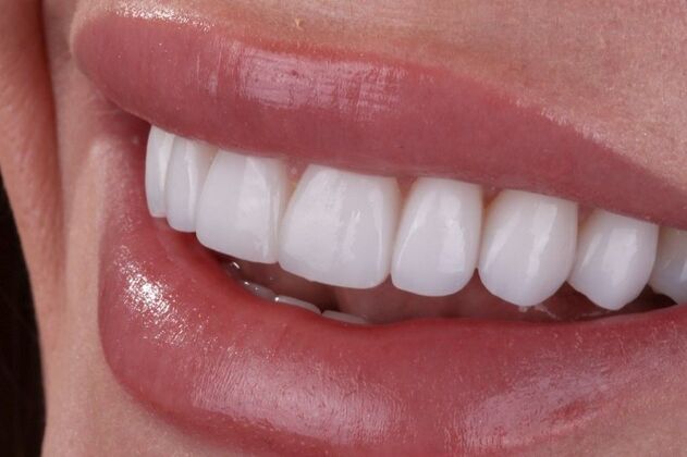Smile Makeover & Veneers: Crystal - After