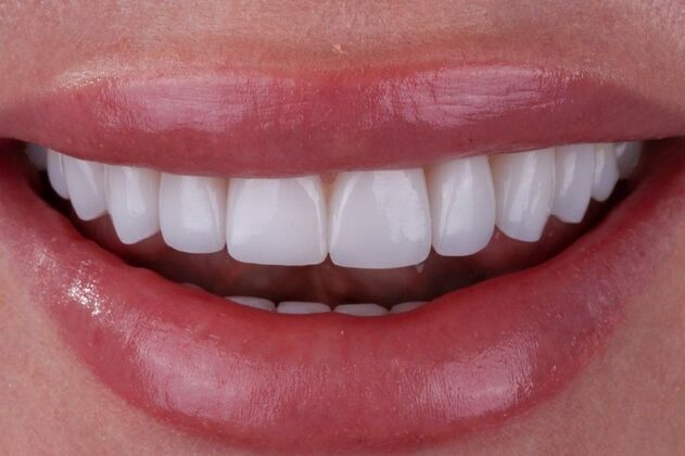 Smile Makeover & Veneers: Crystal - After