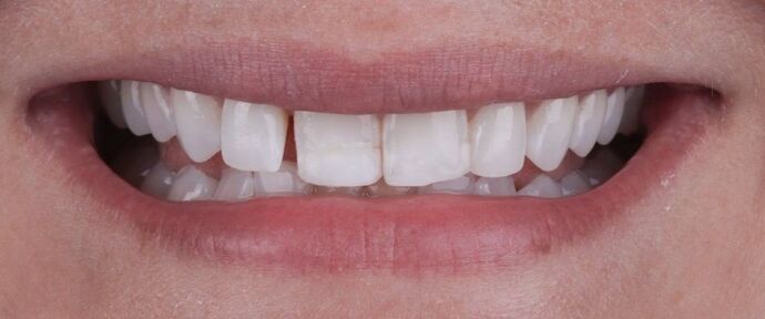 Smile Makeover & Veneers: Tera - Before