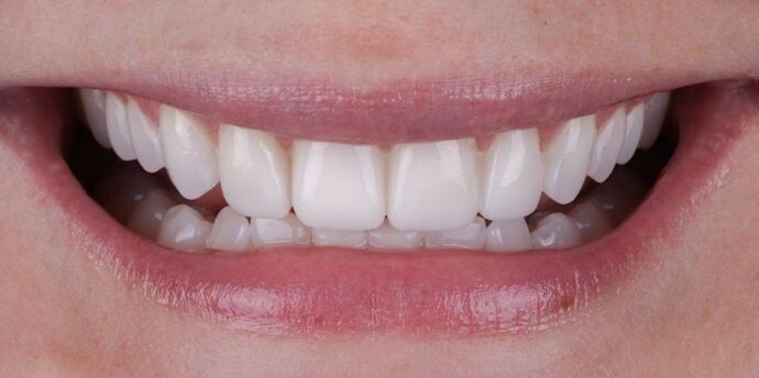 Smile Makeover & Veneers: Tera - After