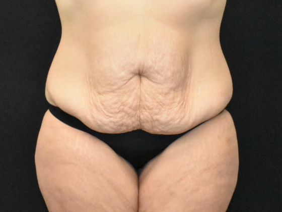 Abdominoplasty Case 31 - Before