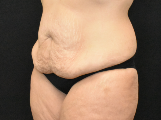 Abdominoplasty: Case 31 - Before