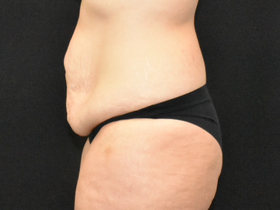 Abdominoplasty: Case 31 - Before