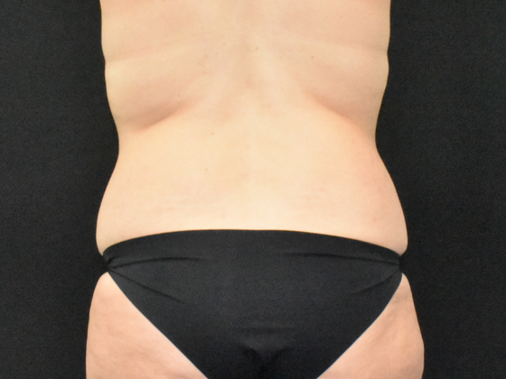 Abdominoplasty: Case 31 - Before