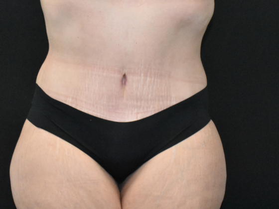Abdominoplasty Case 31 - After