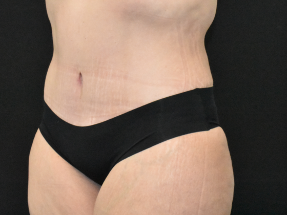 Abdominoplasty: Case 31 - After