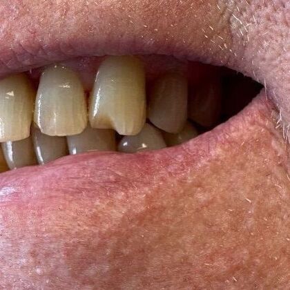 Dental Bonding Case 1 - Before
