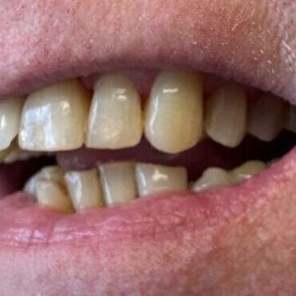 Dental Bonding Case 1 - After