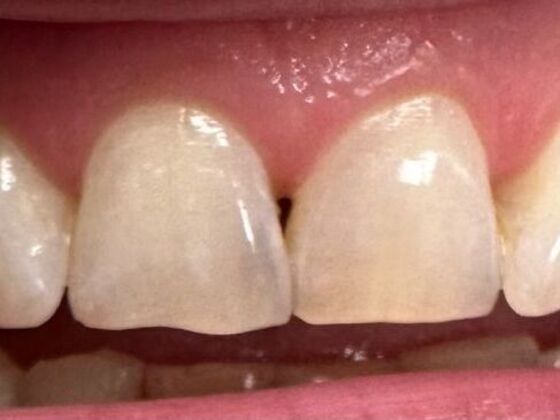 Dental Bonding Case 2 - Before