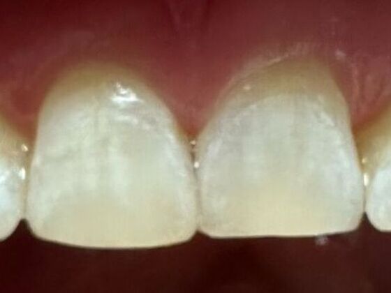 Dental Bonding Case 2 - After