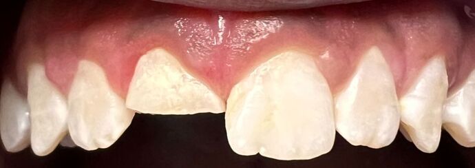 Dental Bonding Case 3 - Before