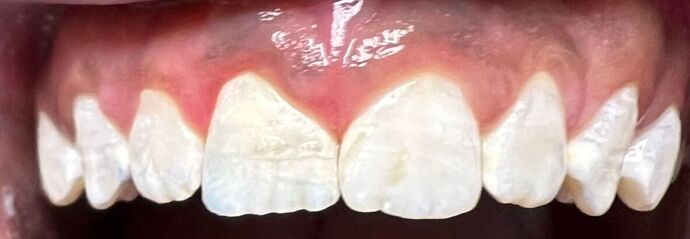Dental Bonding Case 3 - After