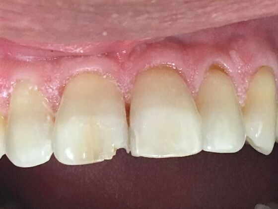 Dental Bonding Case 4 - Before