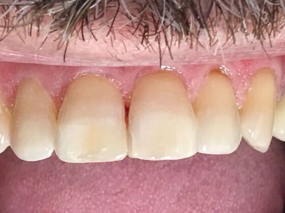 Dental Bonding Case 4 - After