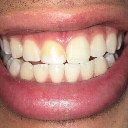 Dental Bleaching Case 1 - Before