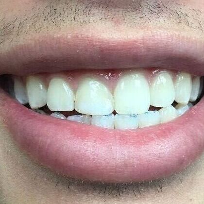 Dental Bleaching Case 1 - After