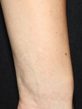 Laser Tattoo Removal Case 41 - After