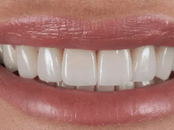 Smile Transformations Case 1 - After