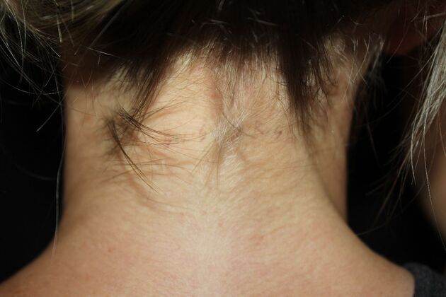 Laser Tattoo Removal Case 44 - After