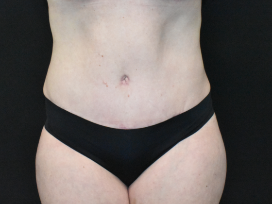 Abdominoplasty Case 32 - After