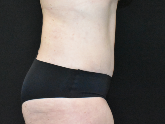 Abdominoplasty: Case 32 - After