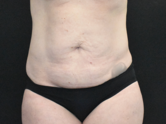 Abdominoplasty Case 32 - Before