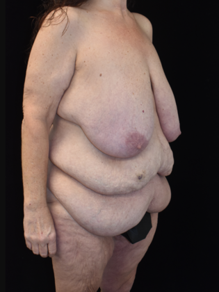 Massive Weight Loss Surgery: Case 2 - Before