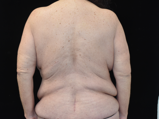 Massive Weight Loss Surgery: Case 2 - Before