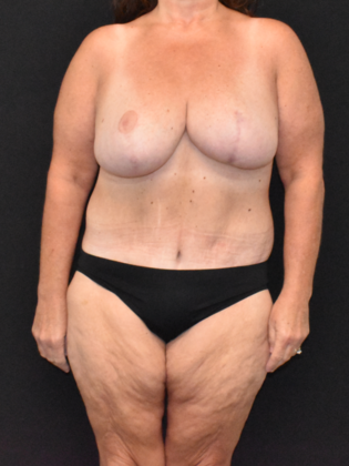 Massive Weight Loss Surgery Case 2 - After