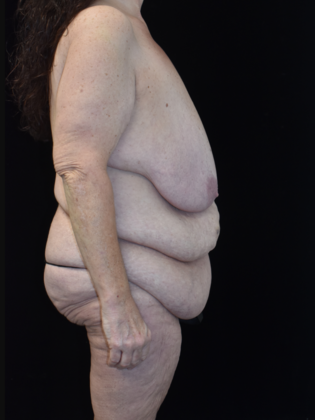 Massive Weight Loss Surgery: Case 2 - Before