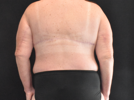 Massive Weight Loss Surgery: Case 2 - After