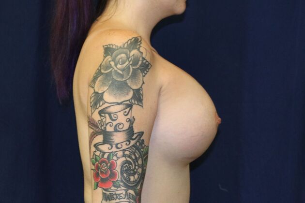 Breast Augmentation*: Case 84 - After