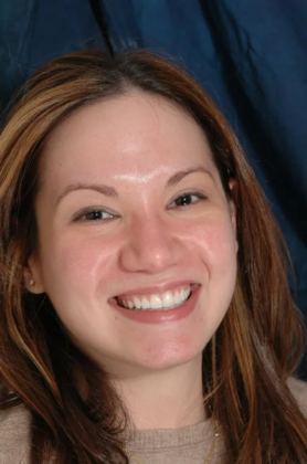 Veneers: Michelle - After