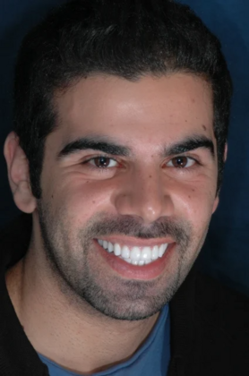 Full Mouth Reconstruction: Saif - After