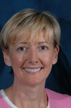 Dental Crowns : Emyleen - After