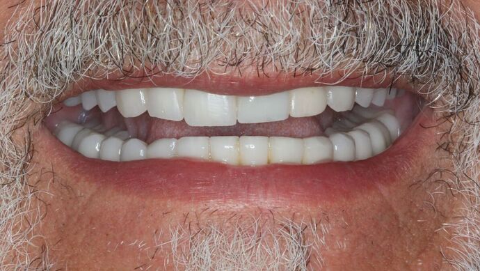 Full Mouth Reconstruction: Case 47 - Before