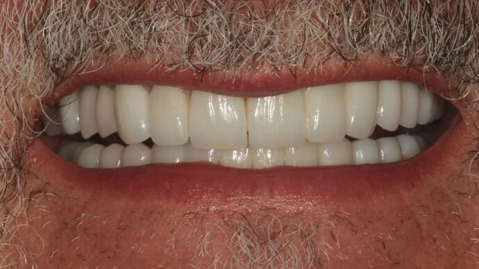 Full Mouth Reconstruction: Case 47 - After