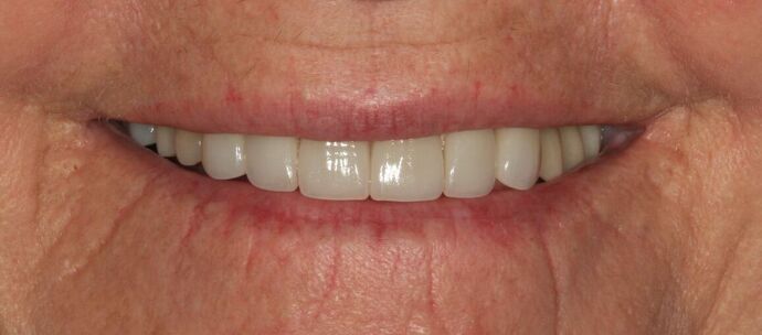 Porcelain Veneers: Case 34 - After