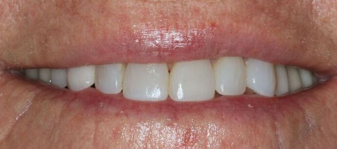 Porcelain Veneers: Case 34 - Before