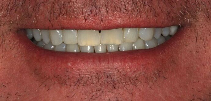 Full Mouth Reconstruction: Case 48 - Before