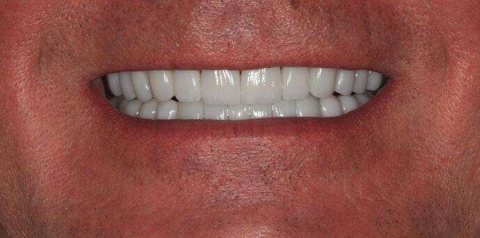 Full Mouth Reconstruction: Case 48 - After