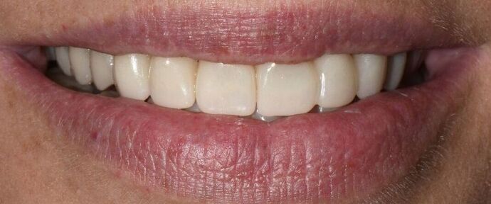 Porcelain Crowns Full Reconstruction Finalized in Porcelain  - After