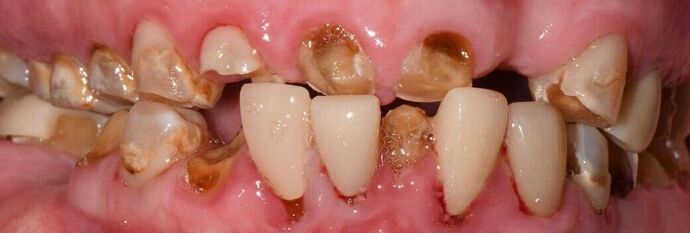 Porcelain Crowns Full Reconstruction Finalized in Porcelain  - Before