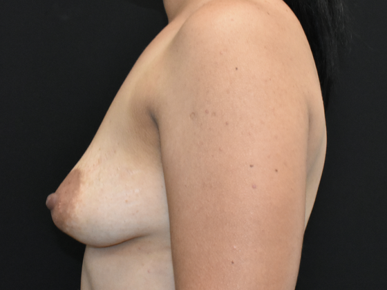 Mastopexy with Augmentation: Case 19 - Before