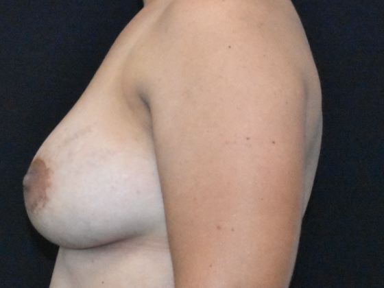 Mastopexy with Augmentation: Case 19 - After