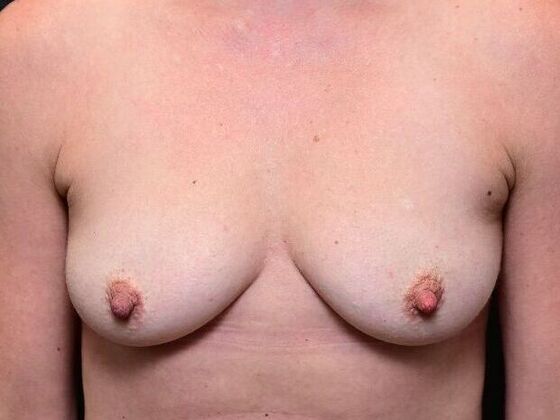Breast Augmentation Case 16 - Before
