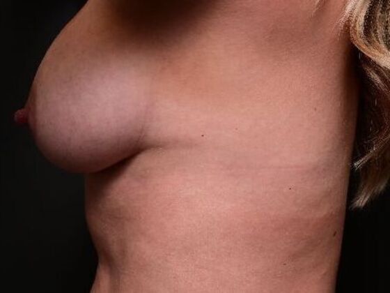Breast Augmentation: Case 16 - After