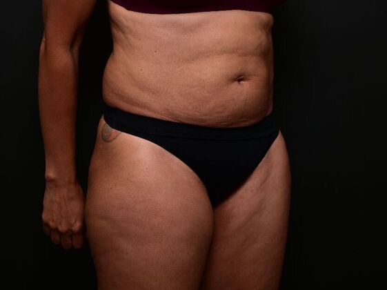 Liposuction: Case 1 - Before